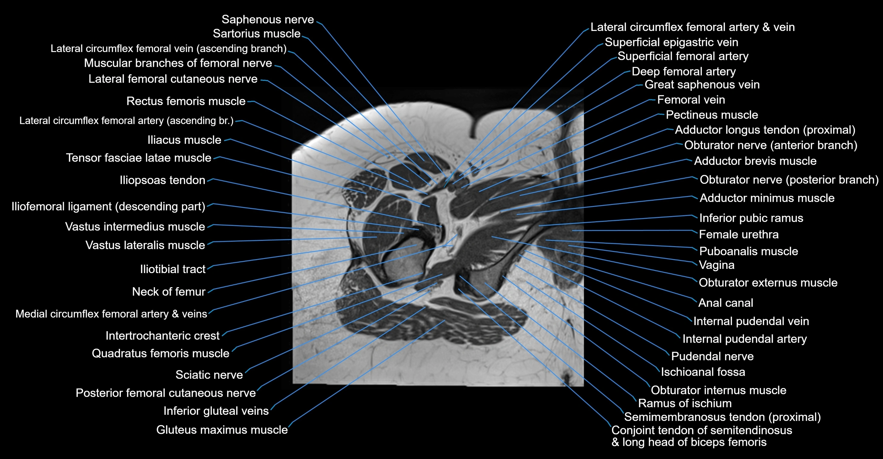 MRI hip axial cross sectional anatomy 3T 3D  radiology  anatomy image-img-00001-00061.webp